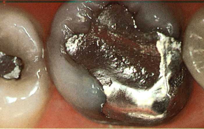 amalgam