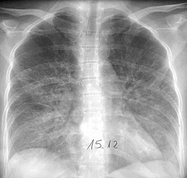 Viral pneumonia