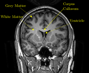 White Matter brain