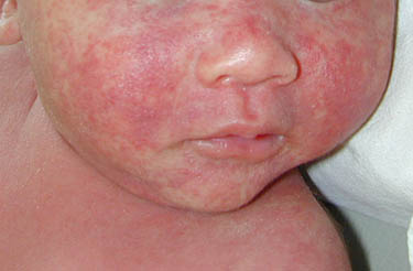 Atypical Measles