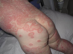Atypical Measles2